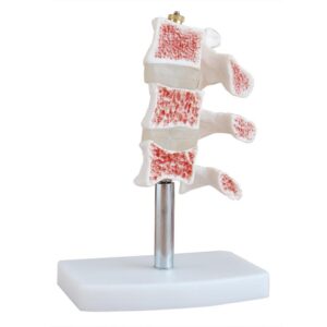 Cutaway Osteoporosis