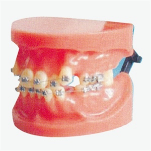 Fixed Orthodontic Model (Dislocation)