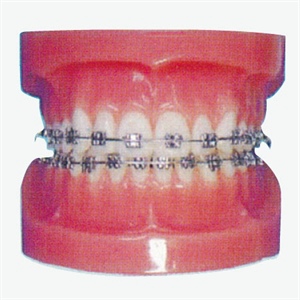 Fixed Orthodontic Model (Normal)