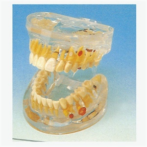 Transparent Dental Pathology Model